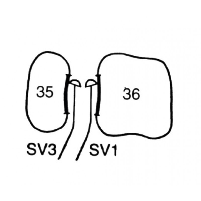 Кюрета пародонтологическая для квадрантов 1 и 3 Interproximal Curette SV 1-3 LM 251-253