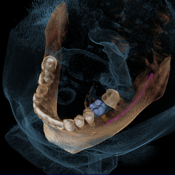 GALILEOS COMFORT PLUS - цифровое рентген устройство для получения высококачественных 3D-изображений всей зоны зубов