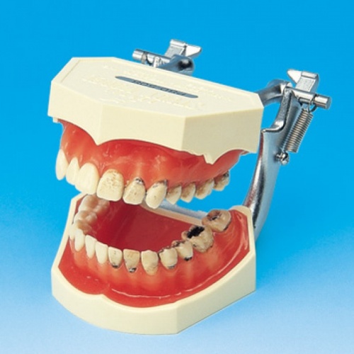 Модель демонстрирующая 4 стадии кариеса (левая сторона) и здоровые зубы (правая сторона)