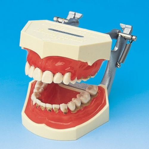 Периодонтальная модель для демонстрации десен, пораженных зубным камнем