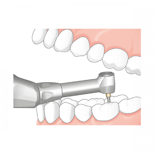 Endo-Mate TC2 MPA - беспроводной эндодонтический микромотор с возможностью быстрого подключения апекслокатора