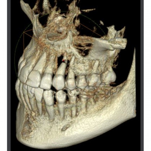 RAYSCAN Symphony a + 120 (3D) - ортопантомограф с компьютерным томографом, 3D (4х13)*(3х10) см