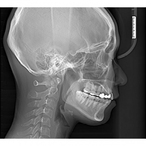 RAYSCAN Symphony a + 120 (3D) - ортопантомограф с компьютерным томографом, 3D (4х13)*(3х10) см