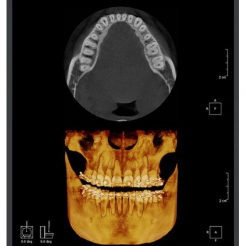 RAYSCAN Symphony a + 120 SM3D - ортопантомограф с цефалостатом 26х24 см и компьютерным томографом 3D (4х13)*(3х10) см